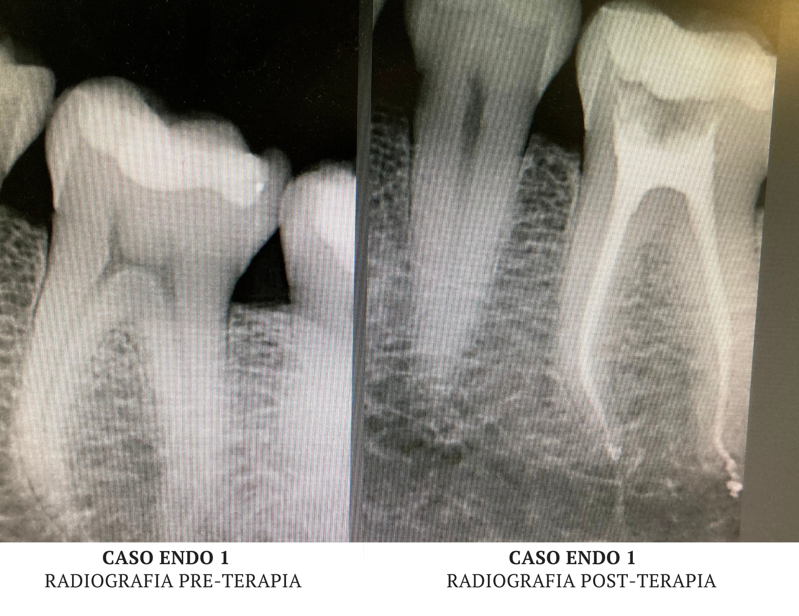Endodonzia Caso 1