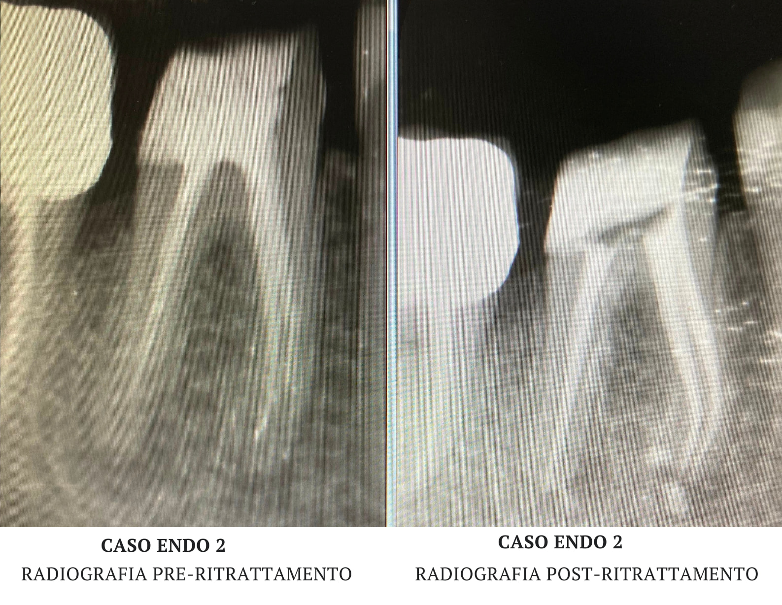 Endodonzia Caso 2