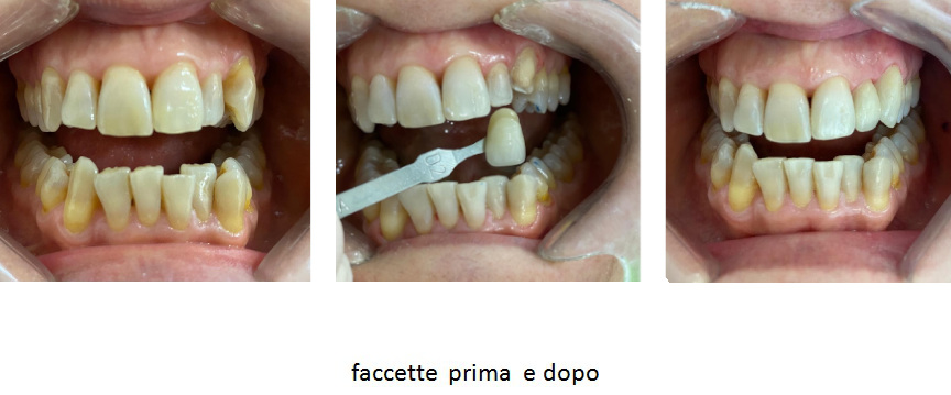 Faccette Dentali Ceramica Bari