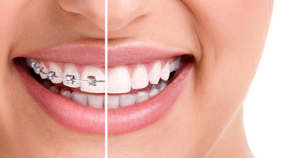 apparecchi ortodontici fissi bari